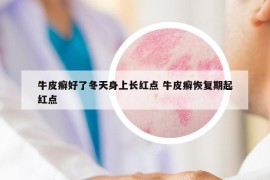 牛皮癣好了冬天身上长红点 牛皮癣恢复期起红点