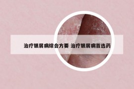 治疗银屑病综合方要 治疗银屑病首选药