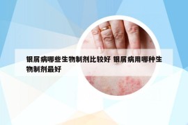 银屑病哪些生物制剂比较好 银屑病用哪种生物制剂最好