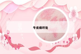 牛皮癣坏处
