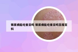 银屑病能吃姜豆吗 银屑病能吃姜豆吗百度百科