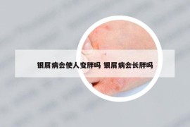 银屑病会使人变胖吗 银屑病会长胖吗