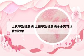 土伏芩治银屑病 土茯苓治银屑病多少天可以看到效果