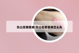 伤口出银屑病 伤口出银屑病怎么办