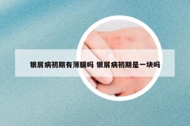 银屑病初期有薄膜吗 银屑病初期是一块吗