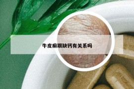 牛皮癣跟缺钙有关系吗