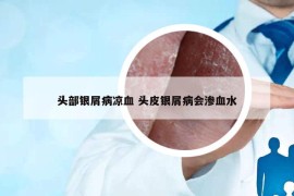 头部银屑病凉血 头皮银屑病会渗血水