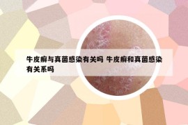 牛皮癣与真菌感染有关吗 牛皮癣和真菌感染有关系吗