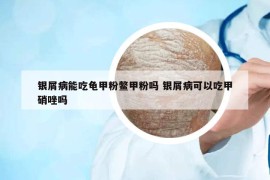 银屑病能吃龟甲粉鳖甲粉吗 银屑病可以吃甲硝唑吗