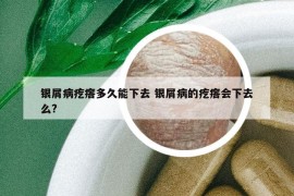 银屑病疙瘩多久能下去 银屑病的疙瘩会下去么?
