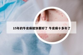 15年的牛皮癣就快要好了 牛皮癣十多年了