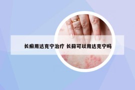 长癣用达克宁治疗 长藓可以用达克宁吗