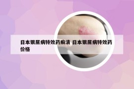 日本银屑病特效药癣清 日本银屑病特效药 价格