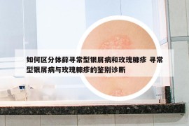 如何区分体藓寻常型银屑病和玫瑰糠疹 寻常型银屑病与玫瑰糠疹的鉴别诊断