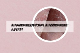 点滴装银屑病是牛皮癣吗 点滴型银屑病用什么药膏好