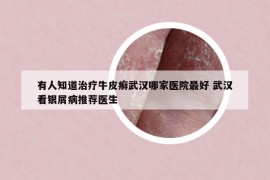 有人知道治疗牛皮癣武汉哪家医院最好 武汉看银屑病推荐医生