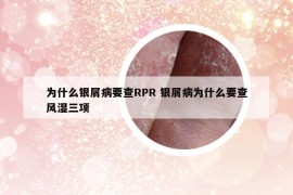 为什么银屑病要查RPR 银屑病为什么要查风湿三项