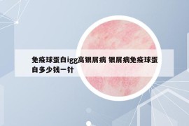 免疫球蛋白igg高银屑病 银屑病免疫球蛋白多少钱一针