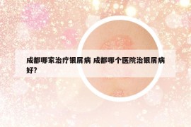 成都哪家治疗银屑病 成都哪个医院治银屑病好?