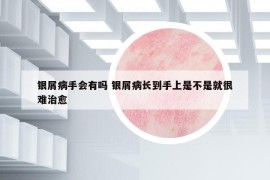 银屑病手会有吗 银屑病长到手上是不是就很难治愈