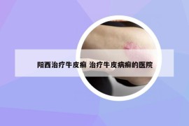阳西治疗牛皮癣 治疗牛皮病癣的医院