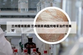 兰州看银屑病 兰州银屑病医院哪家治疗效果好
