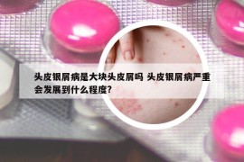 头皮银屑病是大块头皮屑吗 头皮银屑病严重会发展到什么程度?