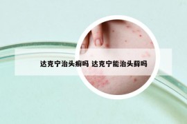 达克宁治头癣吗 达克宁能治头藓吗