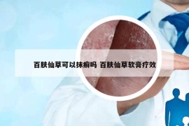 百肤仙草可以抹癣吗 百肤仙草软膏疗效