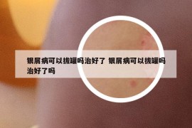 银屑病可以拔罐吗治好了 银屑病可以拔罐吗治好了吗