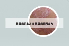 银屑病的土方法 银屑病民间土方