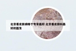 北京看皮肤病哪个专家最好 北京看皮肤科最好的医生