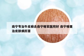 南宁专治牛皮癣去南宁哪家医院好 南宁哪里治皮肤病厉害