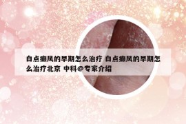 白点癫风的早期怎么治疗 白点癫风的早期怎么治疗北京 中科@专家介绍