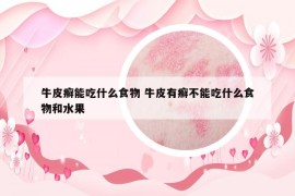 牛皮癣能吃什么食物 牛皮有癣不能吃什么食物和水果