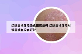 切除扁桃体能治愈银屑病吗 切除扁桃体后对银屑病有没有好处