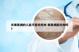 长银屑病的人能不能吃蛇肉 银屑病能吃肉吗?