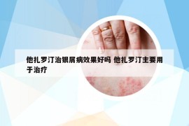 他扎罗汀治银屑病效果好吗 他扎罗汀主要用于治疗