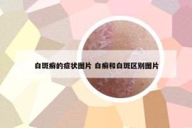 白斑癣的症状图片 白癣和白斑区别图片