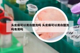 头皮癣可以用白醋洗吗 头皮癣可以用白醋洗吗有用吗