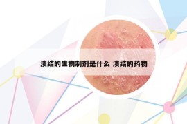 溃结的生物制剂是什么 溃结的药物