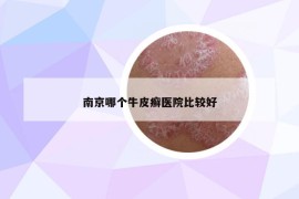 南京哪个牛皮癣医院比较好