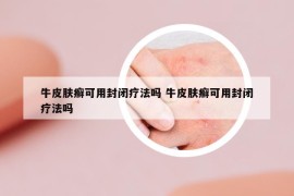 牛皮肤癣可用封闭疗法吗 牛皮肤癣可用封闭疗法吗