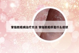 掌指脓疱病治疗方法 掌指脓疱疹是什么症状