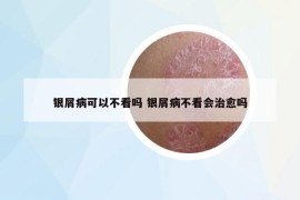 银屑病可以不看吗 银屑病不看会治愈吗