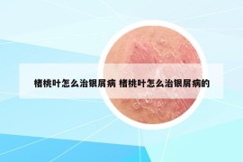 楮桃叶怎么治银屑病 楮桃叶怎么治银屑病的