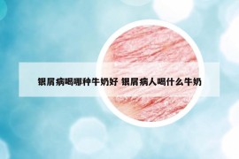 银屑病喝哪种牛奶好 银屑病人喝什么牛奶