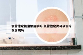 氯雷他定能治银屑病吗 氯雷他定片可以治疗银屑病吗
