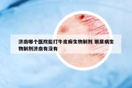 济南哪个医院能打牛皮癣生物制剂 银屑病生物制剂济南有没有