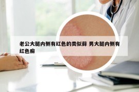 老公大腿内侧有红色的类似藓 男大腿内侧有红色癣